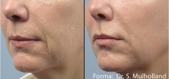 After multiple sessions of Forma to improve tone and smooth wrinkles with no downtime