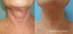 Fractora treatment on the neck to smooth lines and tighten skin