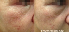 Fractora of the lower eyelids to tighten crepey skin and smooth fine lines