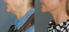 Fractora combined with neck lift surgery skin quality and the complements surgery.