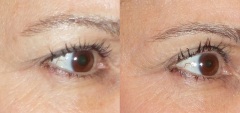 Fractora to tighten the upper eyelid skin without surgery