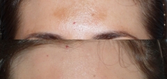 After single treatment with Fraxel Dual for to improve texture and reduce brown pigmentation.