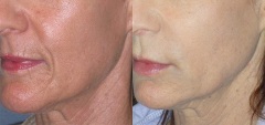 After treatment with Juvederm filler to the laugh lines, marionette lines, lip lines and jawline, creating a “lifted” look.