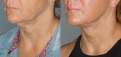 The Deep Plane Minilift combined with the Neck Lift dramatically improves the jawline and neck contour without making the patient look like she has had plastic surgery.