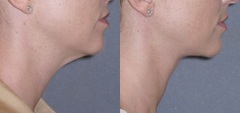 In some patients, a neck lift without a jowl lift is all that is needed. Skin and fat are removed and the muscles are tightened through small incisions.