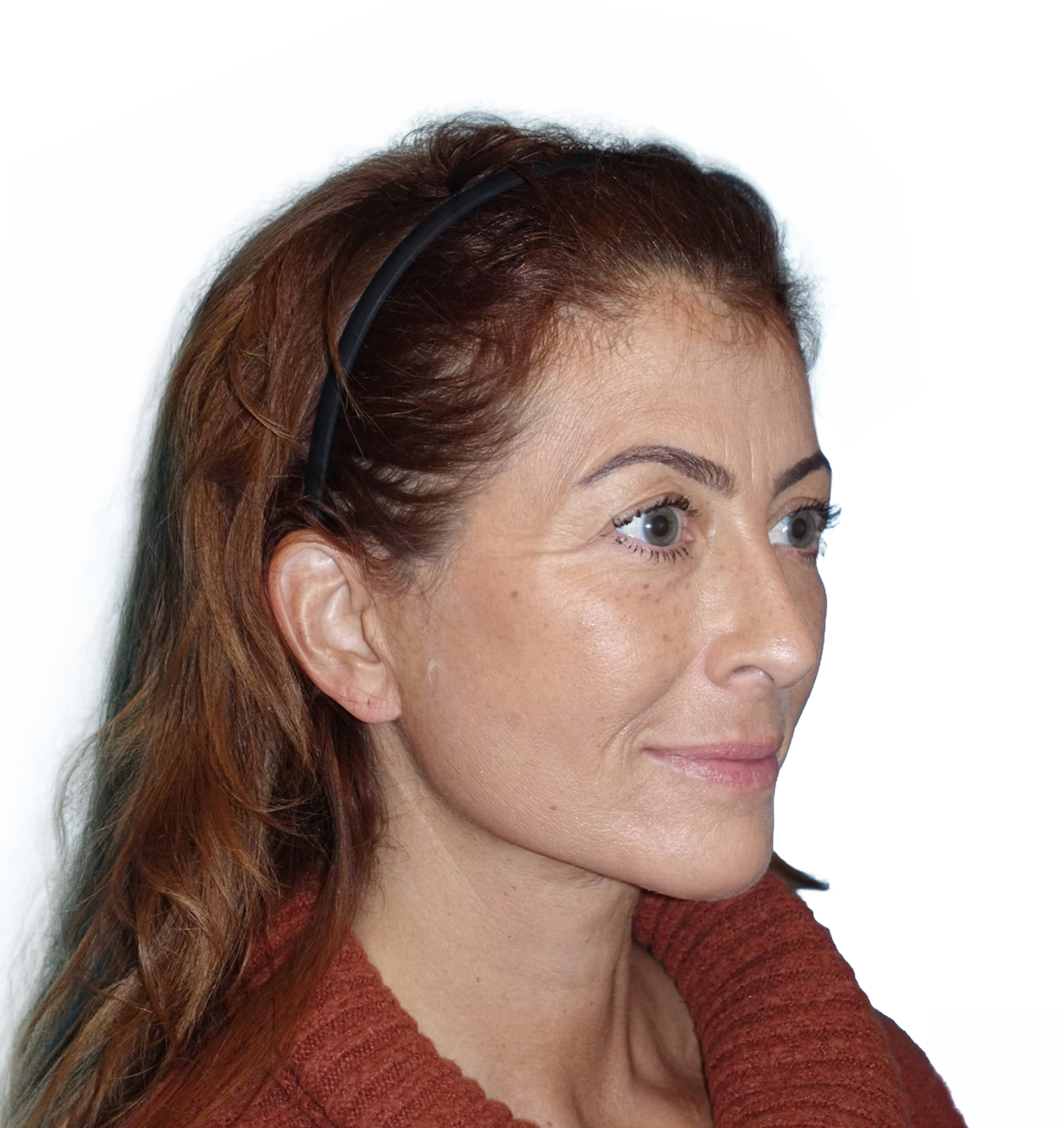 The same Dr. Ahn patient after a deep plane lower face and neck lift, three-quarter view