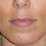 Fraxel Before & After Patient #96