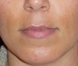 Fraxel Before & After Patient #96