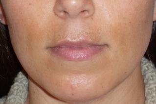Fraxel Before & After Patient #96