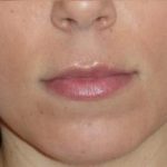 Fraxel Before & After Patient #96