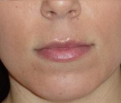 Fraxel Before & After Patient #96