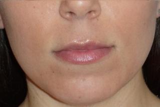 Fraxel Before & After Patient #96