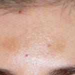Fraxel Before & After Patient #93