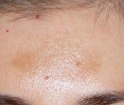 Fraxel Before & After Patient #93