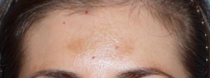 Fraxel Before & After Patient #93