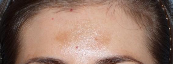 Fraxel Before & After Patient #93