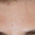 Fraxel Before & After Patient #93