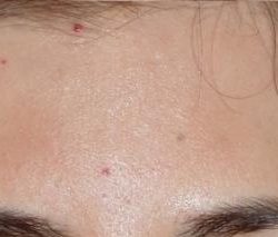 Fraxel Before & After Patient #93
