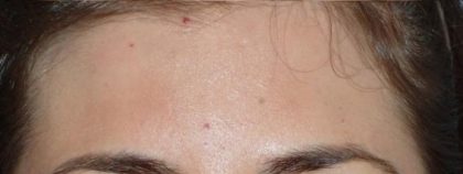 Fraxel Before & After Patient #93