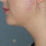 Neck Liposuction Before & After Patient #75