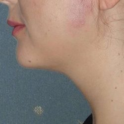 Neck Liposuction Before & After Patient #75