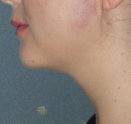Neck Liposuction Before & After Patient #75