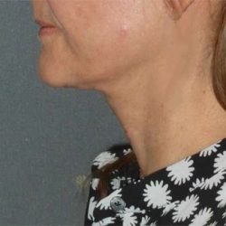 Fractora Before & After Patient #102