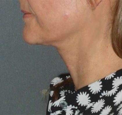 Fractora Before & After Patient #102