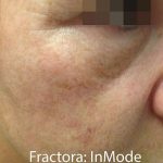 Fractora Before & After Patient #105