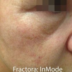 Fractora Before & After Patient #105