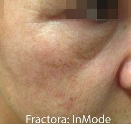 Fractora Before & After Patient #105
