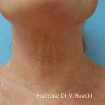 Fractora Before & After Patient #108