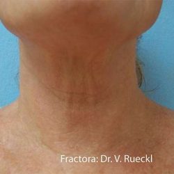 Fractora Before & After Patient #108