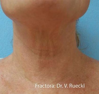 Fractora Before & After Patient #108