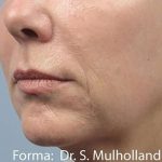 Forma Before & After Patient #111