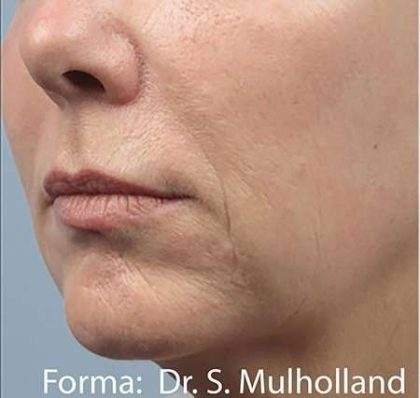 Forma Before & After Patient #111