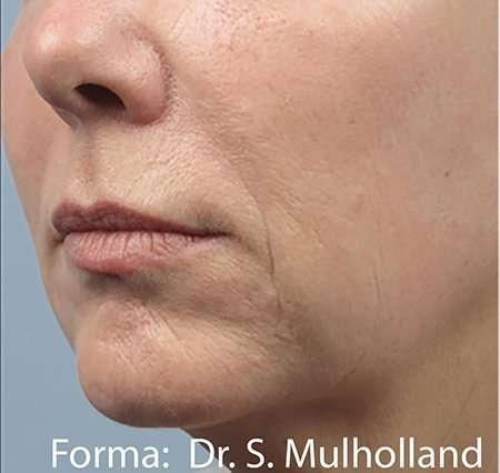 Forma Before & After Patient #111