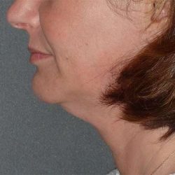 Facetite Before & After Patient #114