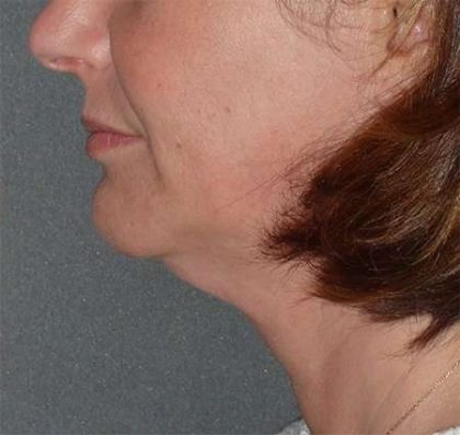 Facetite Before & After Patient #114