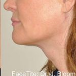 Facetite Before & After Patient #117