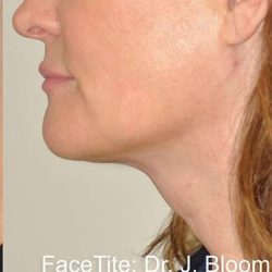 Facetite Before & After Patient #117