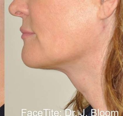 Facetite Before & After Patient #117