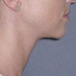 Necklift Before & After Patient #78