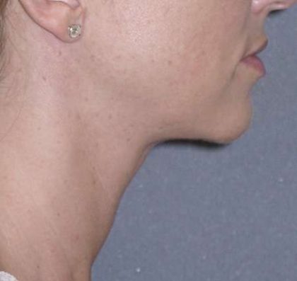 Necklift Before & After Patient #78