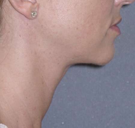 Necklift Before & After Patient #78