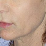 Liquid Lift Before & After Patient #90