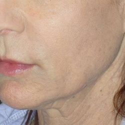 Liquid Lift Before & After Patient #90