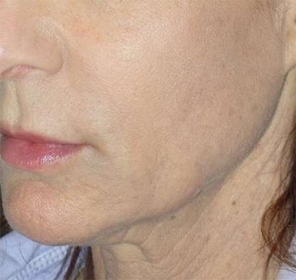 Liquid Lift Before & After Patient #90