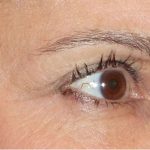 Fractora Before & After Patient #99