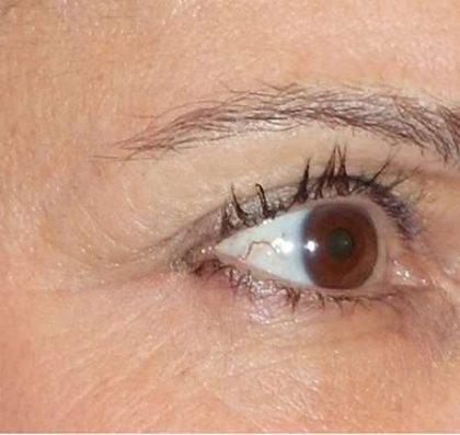 Fractora Before & After Patient #99